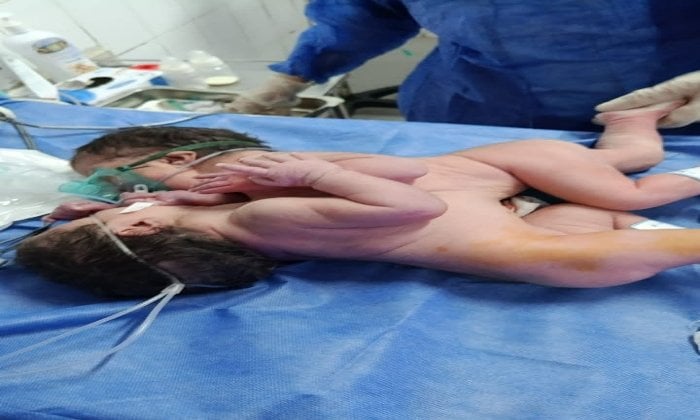توأم ملتصق يشرق من قلب الفيوم العام