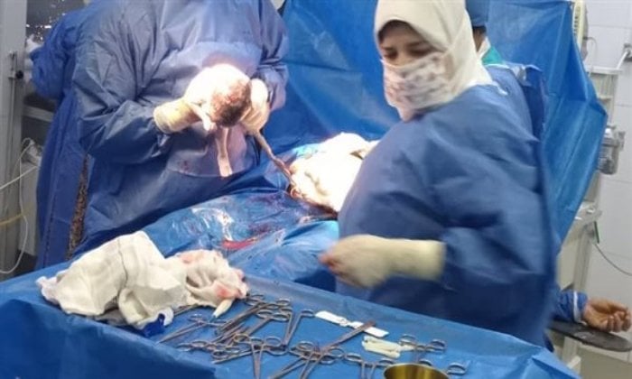 أم تفاجئ العالم بأربعة توائم في المنوفية