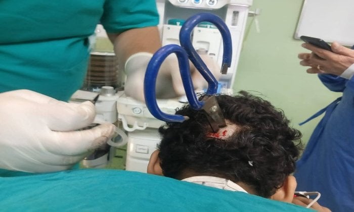 عملية جراحية فريدة: إخراج مقص من جمجمة مريض ببنها