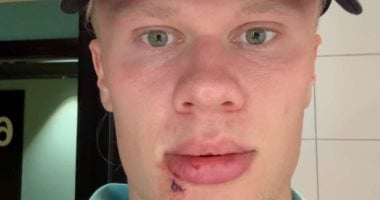 إجراء عملية جراحية لهالاند في معسكر المنتخب النرويجي وسط تكهنات صحفية